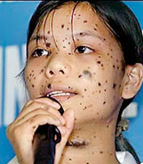 An agent-orange victim in Vietnam