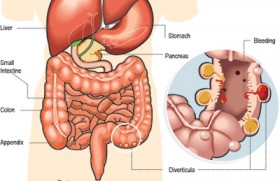 Dealing with Diverticular disease