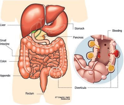 Causes Of Diverticular Disease In Men