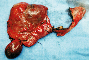 The resected haemangioma