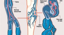 Bye-bye to varicose veins with little pain