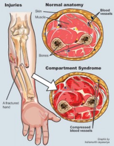 Compartment-Syndrome-F