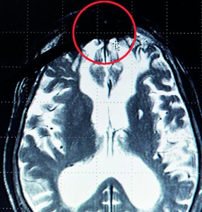 Scans studied by Dr Roth indicate that the patch associated with wicked behaviour is found at the front of the brain