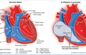 Giving life to little hearts