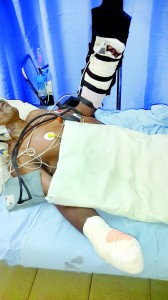 Carpenter  P. Somasiri receiving treatment at hospital and below a  reattached severed hand after surgery. Pix by Reka Tharangani Fonseka