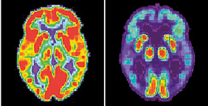 A combination image of brain scans show a normal functioning brain and one with Alzheimers.Reuters