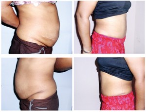 Before and after a tummy tuck