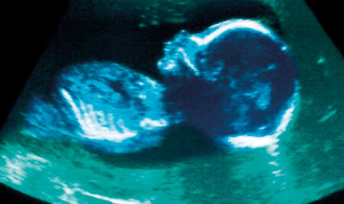 abortion