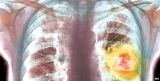 Lung cancer therapy is a ‘milestone’