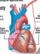 Hybrid heart surgery on staggered basis at two locations