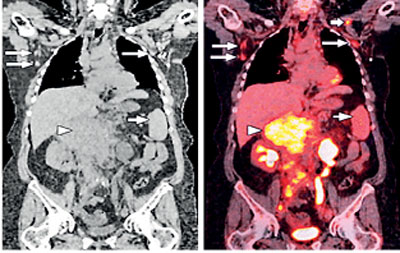 Pet Scan