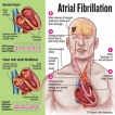 Treat atrial fibrillation before it turns deadly