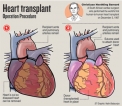 After successful first in heart transplant, Sri Lanka sets sights on lung transplants