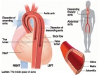 Beware of aortic tear that could mimic a heart attack