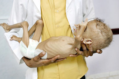 A Yemeni child suffering from malnutrition is carried by a member of hospital staff at a hospital in the district of Aslam in the northwestern Hajjah province on 28 September 2018 (AFP)