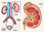 A painful saga of stones in the kidney