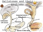 When gallstones need attention