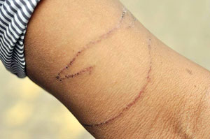 Box-jellyfish-sting-4-days-old