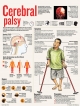 Cerebral palsy