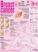 Breast cancer