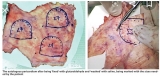 Life-saving Ozaki procedure now in SL