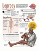 Leprosy Hansen’s disease