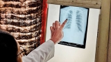 Deaths from tuberculosis rose in 2020: WHO