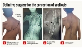 LRH’s spine-curvature corrections in jeopardy LRH’s spine-curvature corrections in jeopardy