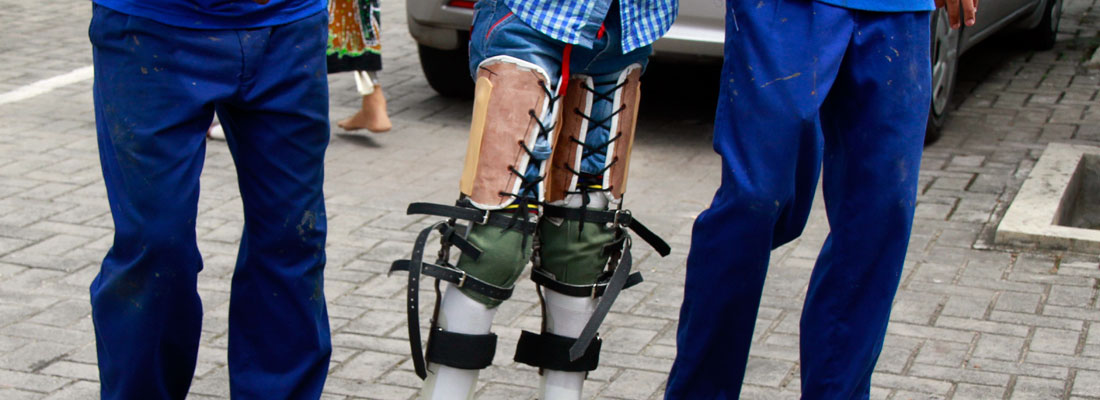 Colombo Friend-in-Need Society: Looking back at big strides taken in prosthetic limbs