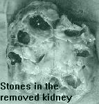 Removed kidney