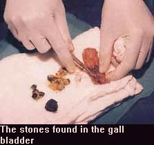 Gall stones