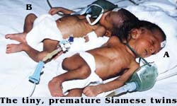 The tiny, premature Siamese rwins